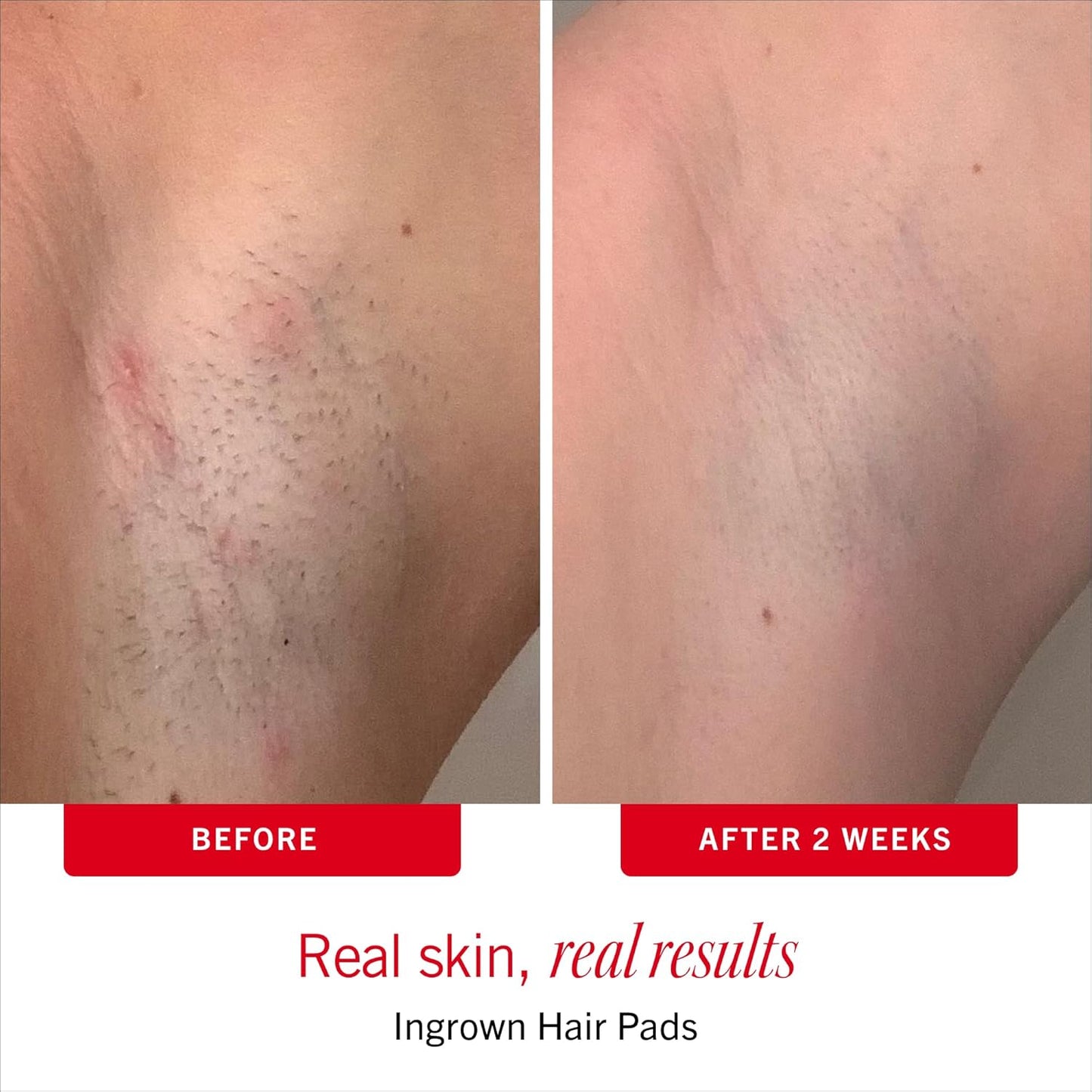 First Aid™ Ingrown Hairs Set